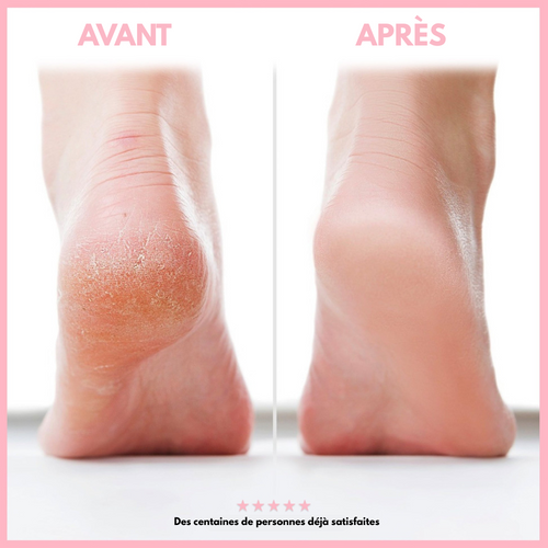 Celisia™ Lissea - La solution anti-callosités et fissures